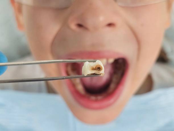 Best Chipped Tooth Repair Near Me  in Harvard, NE